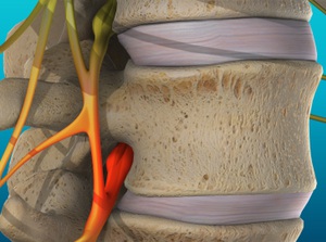 Vertebral subluxation as a condition treatable with chiropractic care